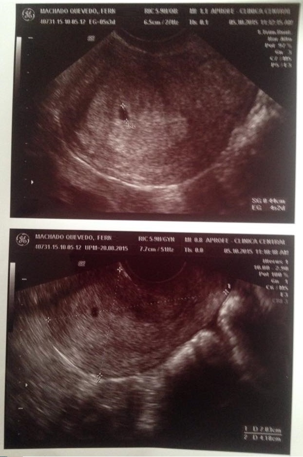 Eco de ambarazo positivo de Fernando Machado y Diane Rodríguez - 2015 - copia